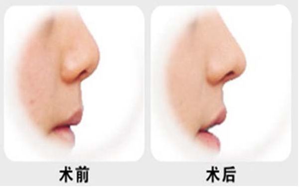 燕雄鼻子整容結(jié)果亮相！專家實(shí)力和成功案例揭秘