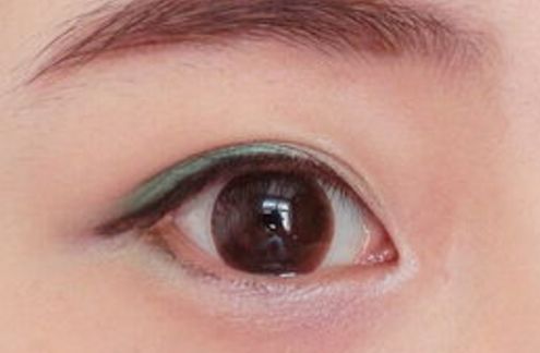 廣州高尚整形美容醫(yī)院隆鼻技術優(yōu)勢揭秘，80天細節(jié)圖曝光！