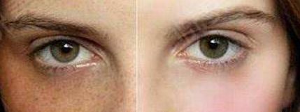 蘇薇潔與楊亞益對比，誰能讓你的雙眼皮完美？實力專家比拼！