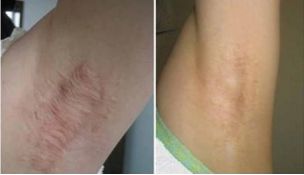 南京哪家醫(yī)院能夠完美實(shí)現(xiàn)雙眼皮手術(shù)的期望？