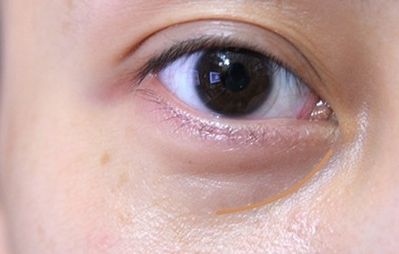 重慶美萊鄭楠醫(yī)生眼部整形術(shù)情況、資料及價格請參考