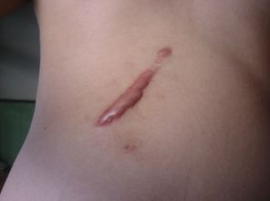 滄州靜港醫(yī)院雙眼皮手術(shù)效果如何？哪位醫(yī)生值得信賴？手術(shù)費用參考表同步分享