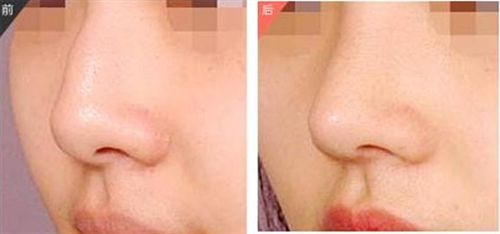 廣元著名醫(yī)生達(dá)芬奇教你如何擁有完美雙眼皮