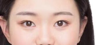 山東省立醫(yī)院整形外科激光祛斑真的有效嗎？