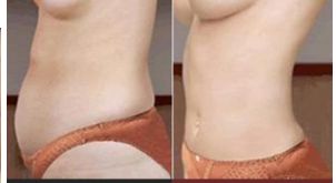 美容整形的切口位置如何選擇？