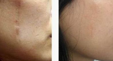 國(guó)內(nèi)有哪些值得推薦的磨骨權(quán)威專家？?jī)?yōu)秀磨骨師張笑天、李志海等值得關(guān)注