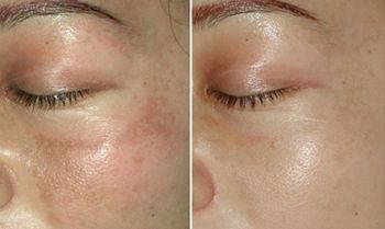 李天石做眼皮手術(shù)費(fèi)用昂貴？個(gè)人體驗(yàn)分享：三個(gè)月改變！