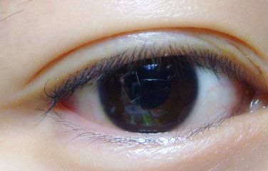 健麗整形醫(yī)院的去眼袋效果如何？2023患者分享案例！