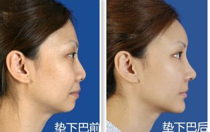 上海九院鼻部整形手術(shù)專家李圣利，專業(yè)水準(zhǔn)如何？