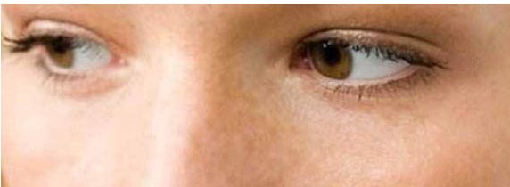 想改善雙眼皮？來鄭州三院看看王江允！了解費(fèi)用可參考2023價(jià)格表。