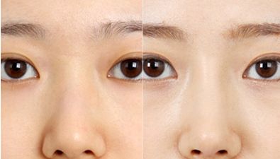 專業(yè)排行榜出爐！北京最頂級(jí)雙眼皮醫(yī)生名單公布！