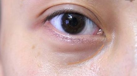 湘雅龍劍虹：雙眼皮案例解析及專業(yè)醫(yī)生簡介