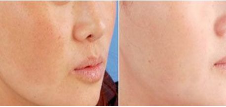 朱海男全切雙眼皮手術(shù)費用及醫(yī)生簡介、價格表解析！