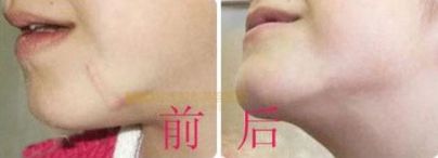 上海哪家醫(yī)院有專(zhuān)業(yè)的唇裂手術(shù)醫(yī)生？治療兔唇患者的必備信息！