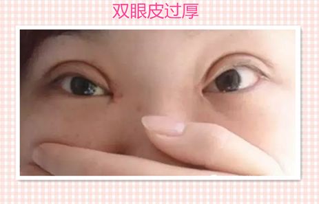 鄭州東方整形醫(yī)院大腿吸脂術：醫(yī)生解讀及成功案例分享