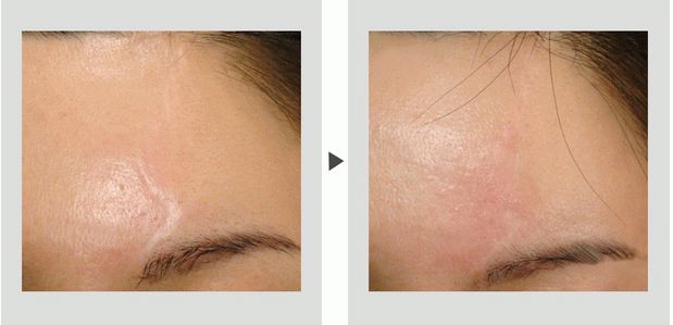 北京八大處哪個整形醫(yī)院的雙眼皮手術效果好？推薦醫(yī)生和價格！