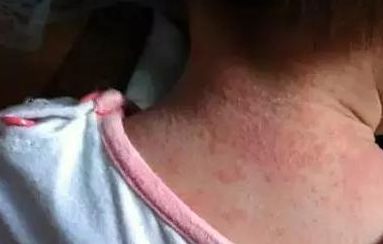 黃開亮眼睛美不美，醫(yī)生經(jīng)驗(yàn)公開！看雙眼皮整形成功案例