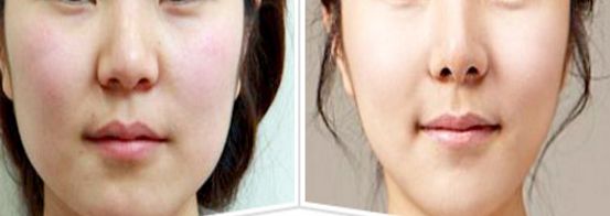 崔寓植鼻子效果如何？這個案例真實又自然！