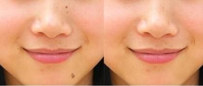 上海九院李茅醫(yī)生的雙眼皮手術效果如何？90天見證分享給你！