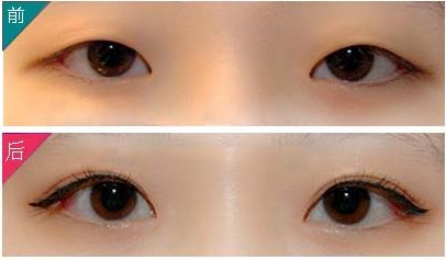 九院朱海男雙眼皮手術(shù)效果與價(jià)格一覽，了解最新資訊！