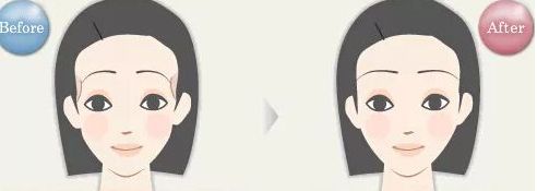 揭密石家莊哪位雙眼皮醫(yī)生備受關(guān)注，優(yōu)點揭秘，價格參考！