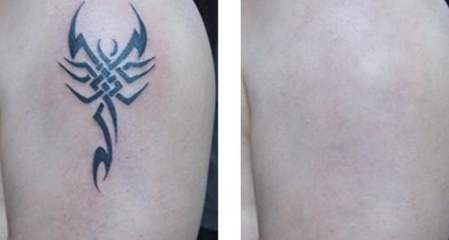 宋建星吸脂修復(fù)效果好嗎？吸脂修復(fù)宋建星技術(shù)如何？