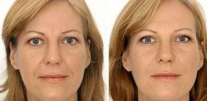 什么是硅膠隆胸手術(shù)后的風(fēng)險和并發(fā)癥？數(shù)據(jù)顯示存在術(shù)后位置異常和假體外露等狀況