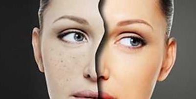 湘雅醫(yī)院美容整形外科如何消除眼袋？了解專家解決方案及案例分享