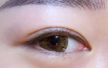 鄒翀，這一雙眼皮技術(shù)，近期有所革新