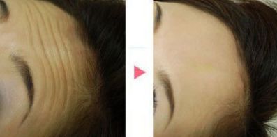 成都藝星周順波做鼻整形效果及費(fèi)用詳解