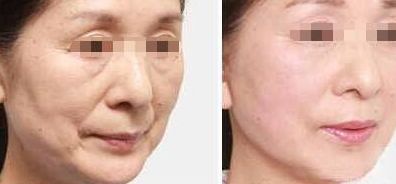 寧波頂級醫(yī)院去眼袋的價(jià)格及經(jīng)驗(yàn)分享