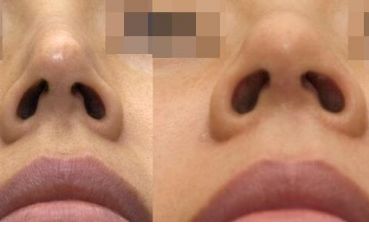 南寧整形醫(yī)院治療疤痕效果如何？最佳選擇揭秘