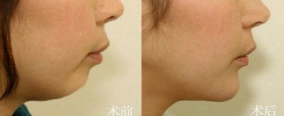 廣州哪些整形醫(yī)院效果好？排名前十的吸脂醫(yī)院有哪些？