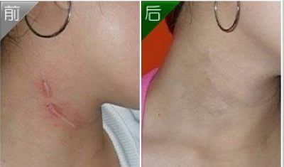 廣州隆胸手術(shù)費(fèi)用及案例分享，口碑如何？