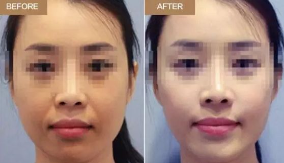 廈門五家口碑佳的隆鼻醫(yī)院，實(shí)力皆不俗