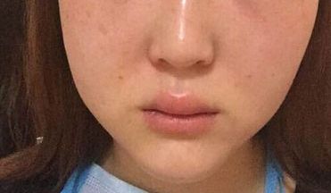 廣州美恩顧榮雙眼皮手術(shù)經(jīng)驗(yàn)分享：90天親測(cè)案例展示