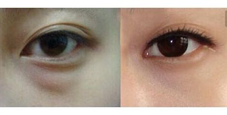 羅日云整容醫(yī)生的服務(wù)及費(fèi)用詳情，隱私公開！優(yōu)質(zhì)雙眼皮案例與收費(fèi)一覽供參考！