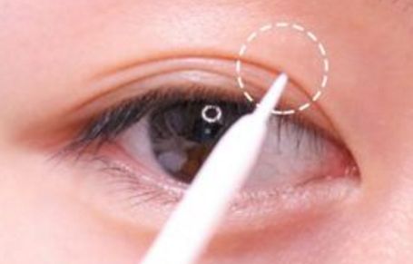 北京美聯(lián)臣路世敏醫(yī)生幫你告別歲月痕跡！除皺案例分享！