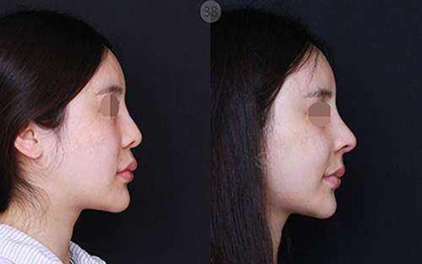 重慶美萊整形四月特惠，是不是只需6000元即可減400元？雙眼皮可以實現(xiàn)嗎？