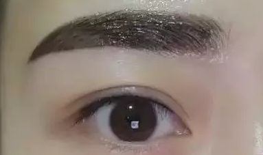 浙二醫(yī)院葉娟為患者打造完美雙眼皮，成就精致美眸