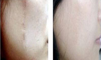 東莞人民醫(yī)院皮膚科的抗皺注射案例分享，讓您恢復(fù)年輕面容