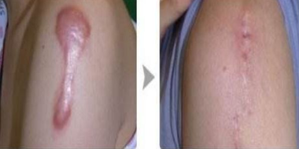 武漢仁愛時(shí)光醫(yī)療美容醫(yī)院優(yōu)質(zhì)案例分享，自體脂肪隆胸效果如何？