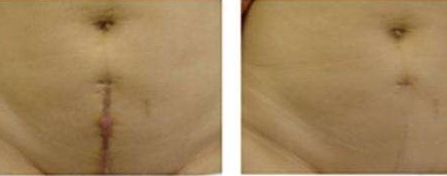 重慶張恒術(shù)進(jìn)行雙眼皮手術(shù)，醫(yī)生實(shí)力以及成功案例展示