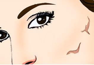 張曉建拉皮的效果好不好？如何評價？