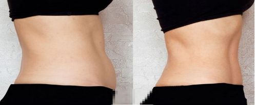 英諾小棕瓶的微針和滾針，如何選擇？英諾小棕瓶反黑效果需要多久呢？