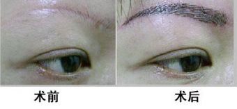 濟(jì)南雙眼皮手術(shù)有哪些值得推薦的醫(yī)院