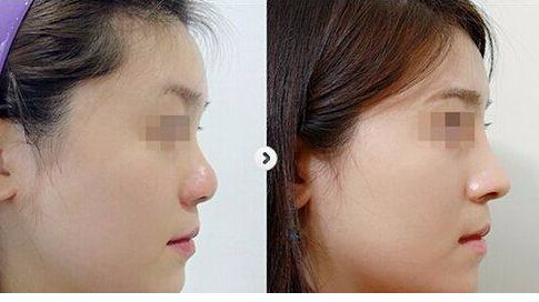 揭秘廣州整容界很受推崇的隆鼻醫(yī)生排行榜！TOP10豪華陣容對(duì)決，尊貴專家非一般醫(yī)師！