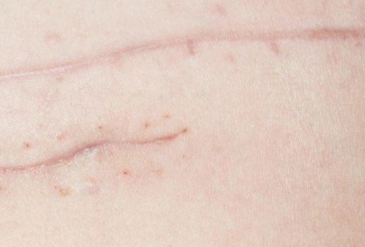 桂林華美醫(yī)院：胡凱鼻子整形前后效果大揭秘！看圖真相引人矚目