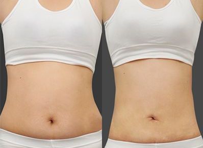 青島去哪家醫(yī)院做吸脂整形效果好，有口碑推薦？5家值得關(guān)注的專業(yè)醫(yī)院推薦