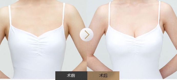 全面了解雙眼皮手術(shù)，揭秘風(fēng)險(xiǎn)與安全